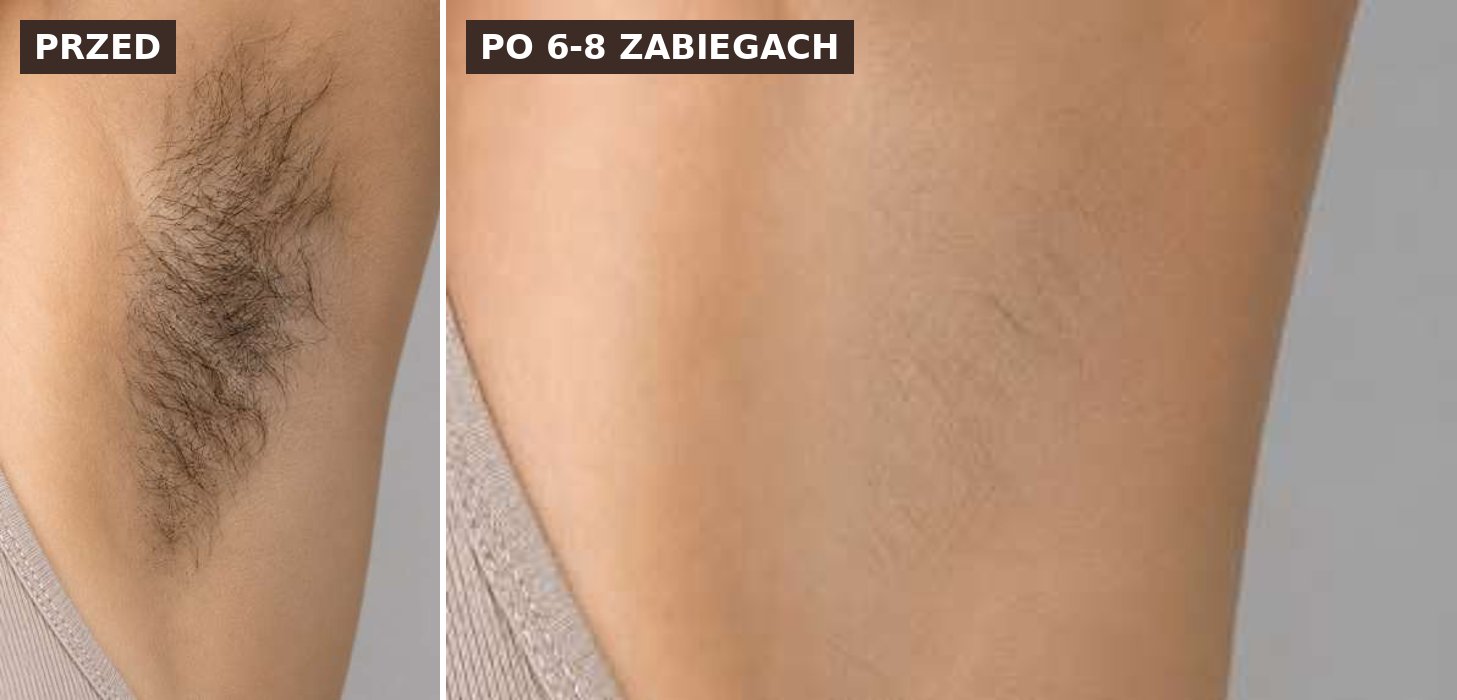 Efekt przed i po — depilacja laserowa LASERRIX