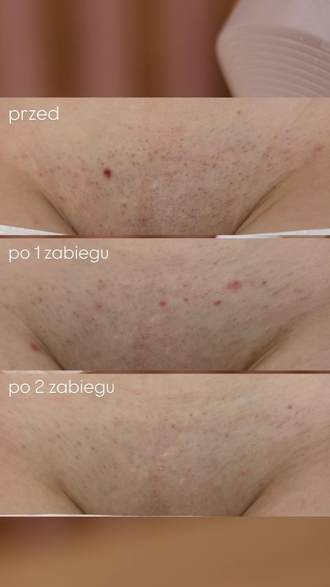 Depilacja laserowa okolicy wzgórka łonowego — po 2 zabiegach, przed · po 1 · po 2