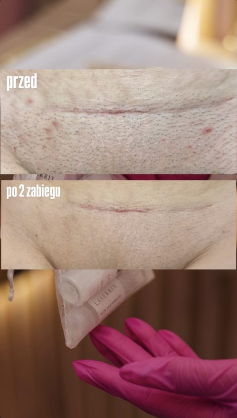Depilacja laserowa okolicy wzgórka łonowego — po 2 zabiegach, przed i po