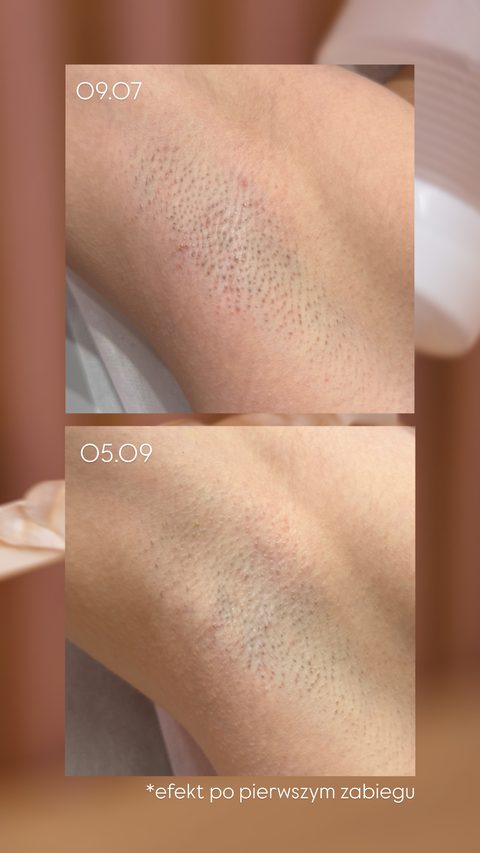 Depilacja laserowa pach — po 1 zabiegu, 09.07 → 05.09