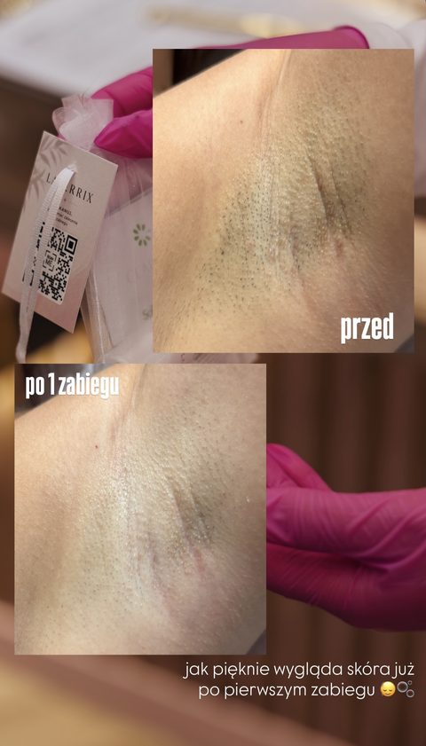 Depilacja laserowa pach — po 1 zabiegu, przed i po