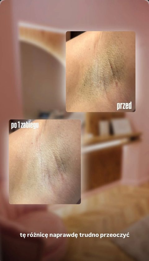 Depilacja laserowa pach — po 1 zabiegu, przed i po