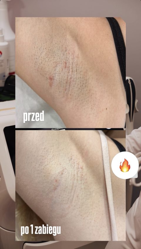 Depilacja laserowa pach — po 1 zabiegu, przed i po