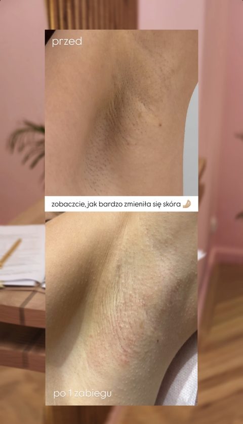 Depilacja laserowa pach — po 1 zabiegu, przed i po