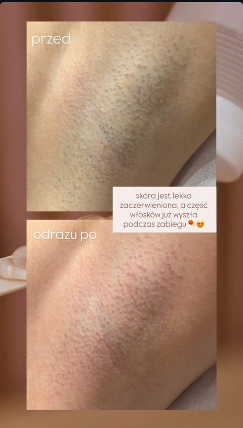 Pacha przed zabiegiem i zaraz po nim: lekkie zaczerwienienie, część włosów wychodzi już w trakcie