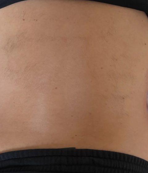 Depilacja laserowa pleców — po 2 zabiegach, dół pleców · zdjęcie z opinii w Google