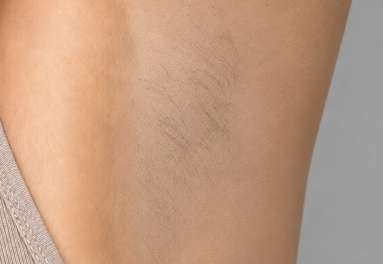 Pachy po 4-5 zabiegach depilacji laserowej