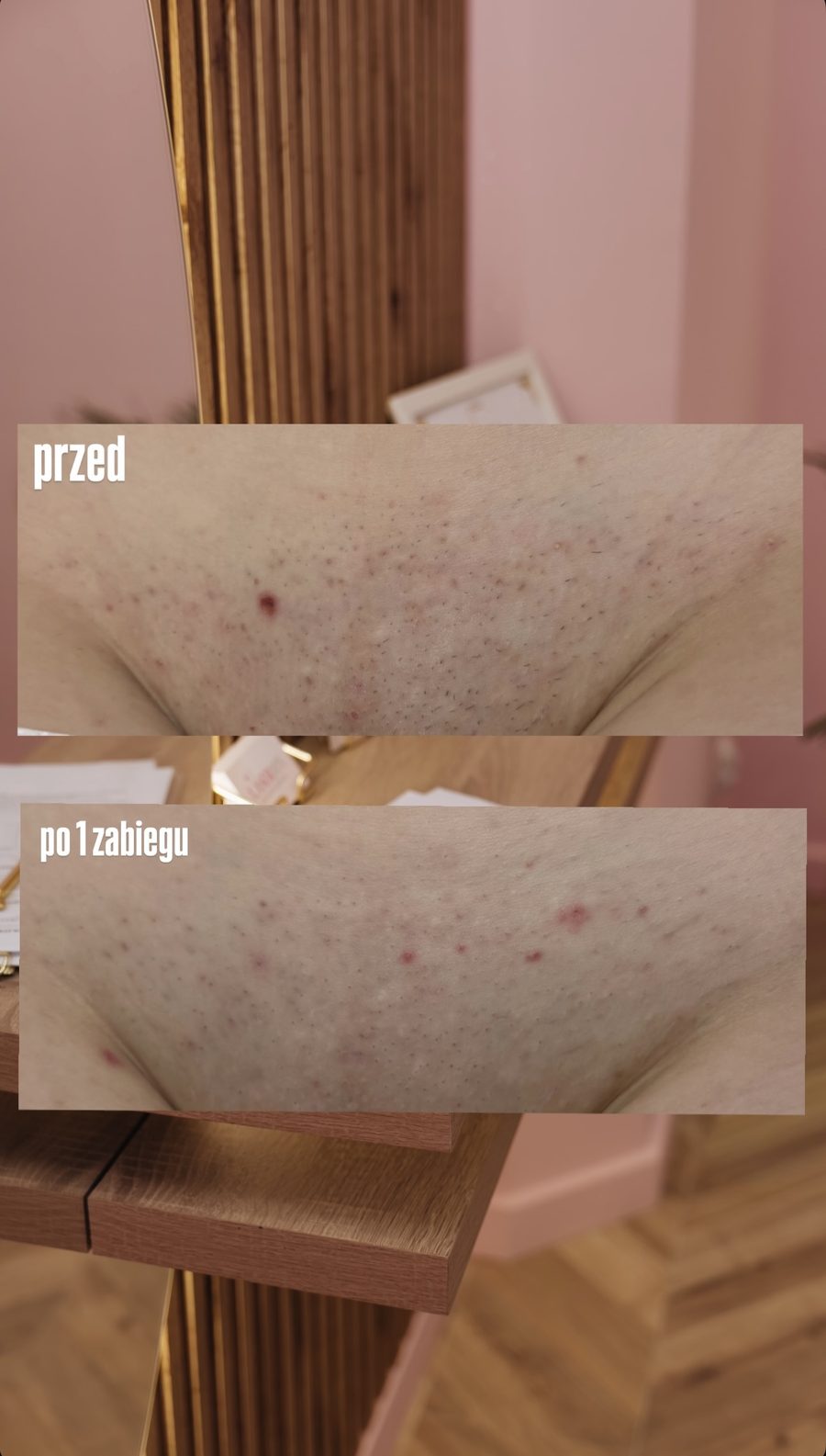 Bikini — efekt po 1 zabiegu depilacji laserowej