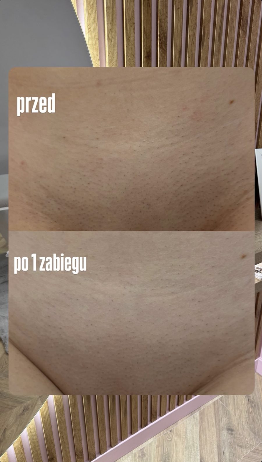 Bikini — efekt po 1 zabiegu depilacji laserowej