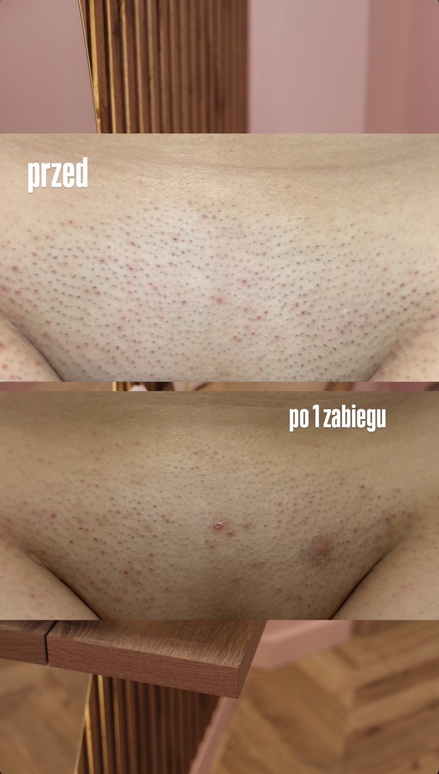 Bikini — efekt po 1 zabiegu depilacji laserowej