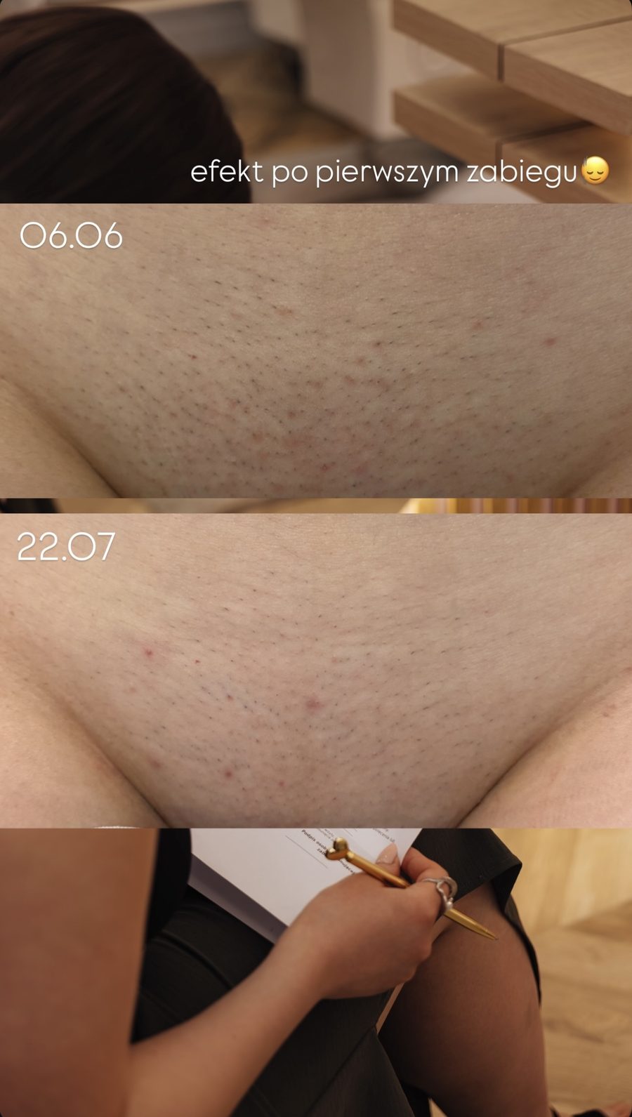 Bikini — efekt po 1 zabiegu depilacji laserowej