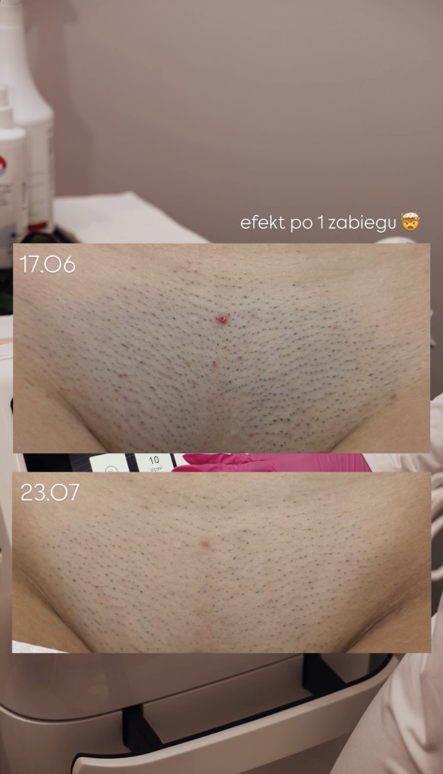 Bikini — efekt po 1 zabiegu depilacji laserowej