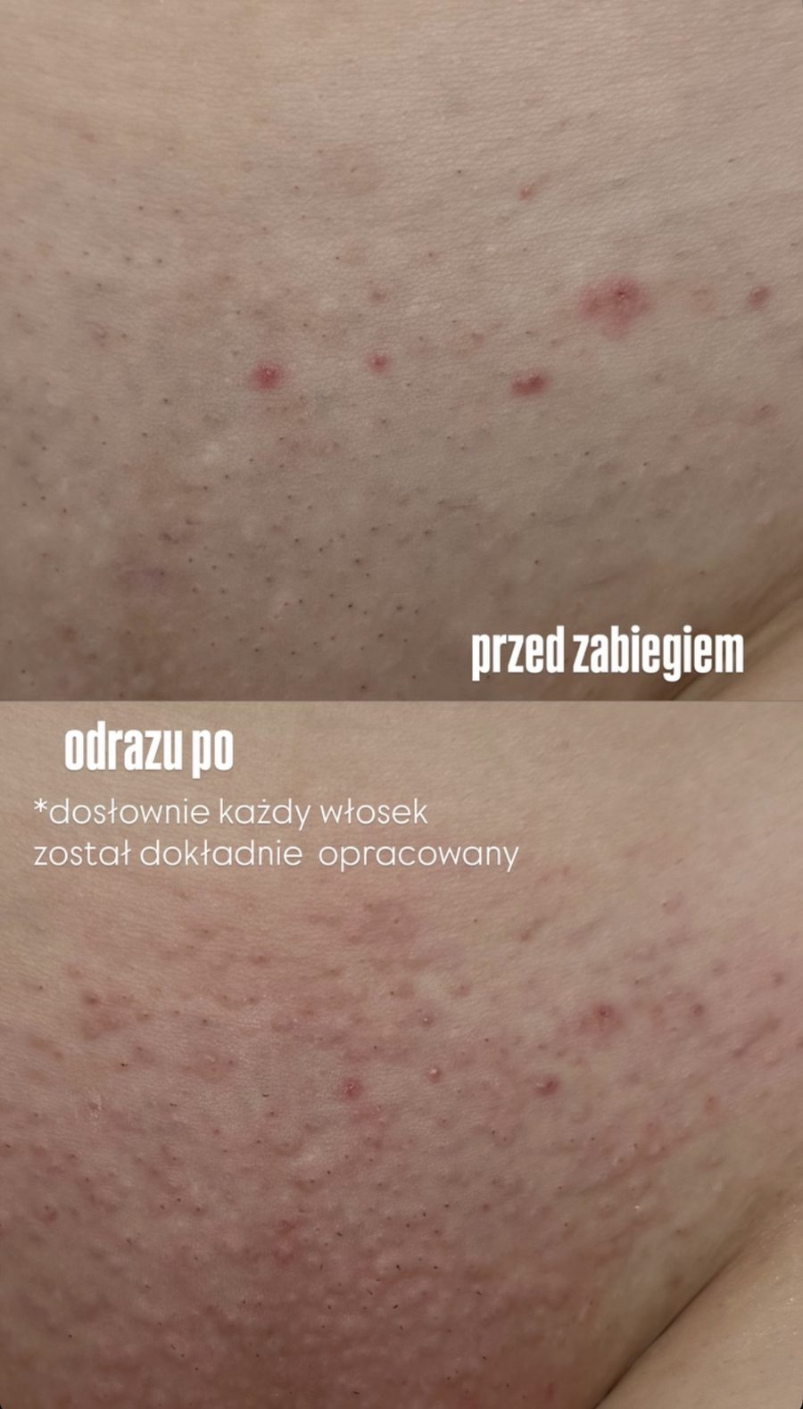 Bikini — efekt bezpośrednio po zabiegu depilacji laserowej