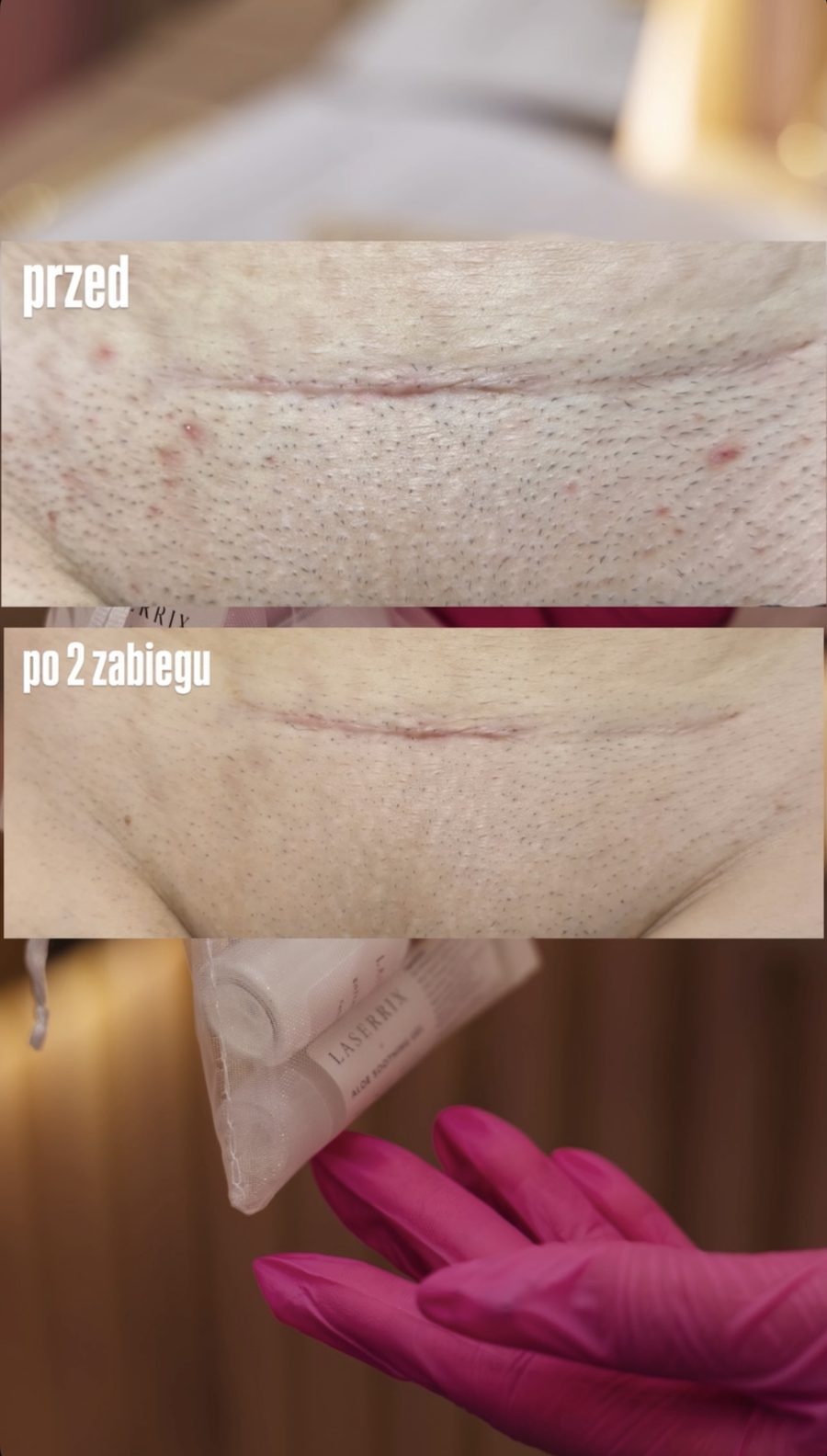 Bikini — efekt po 2 zabiegach depilacji laserowej