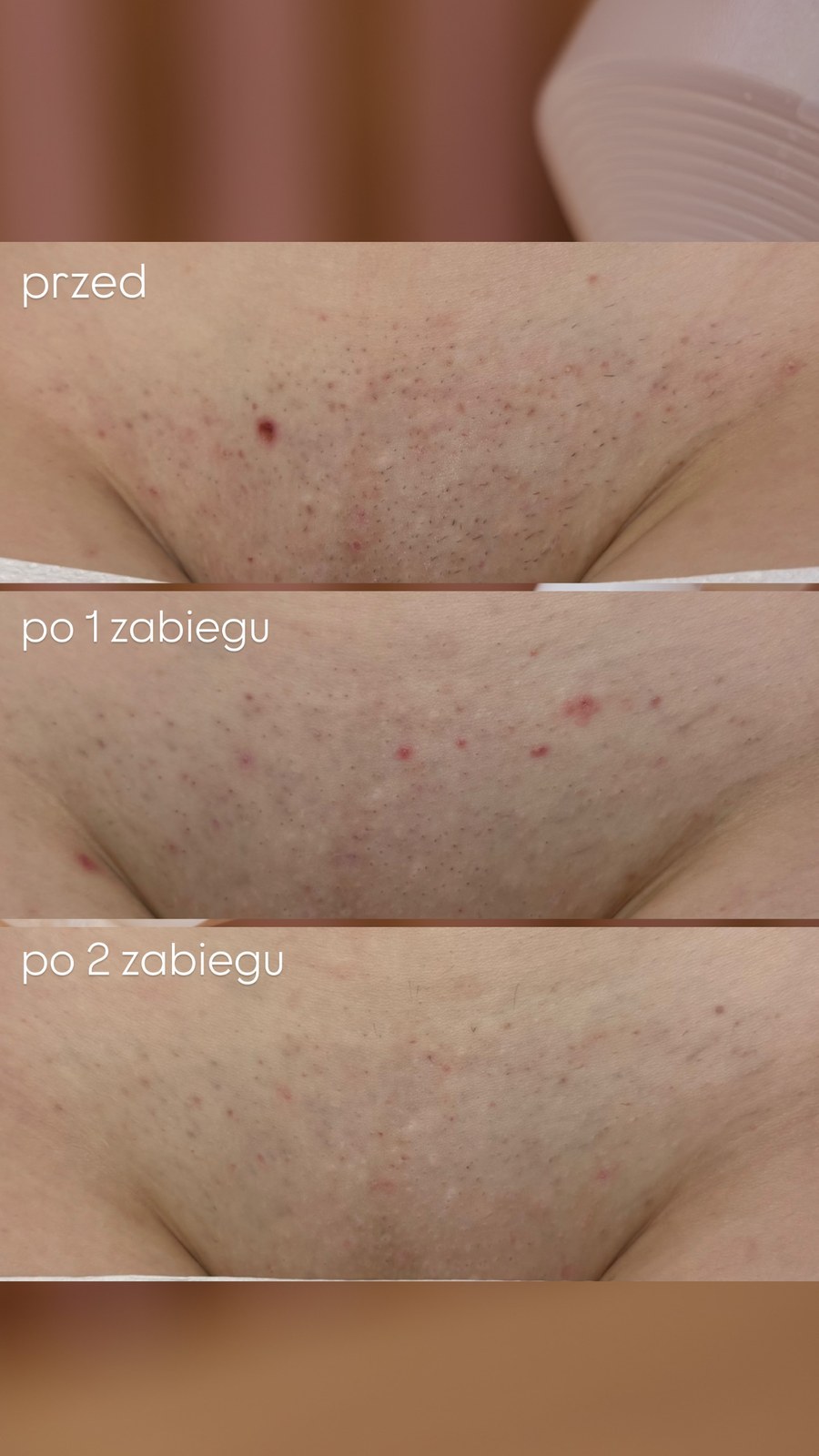 Efekt depilacji laserowej bikini — realny przypadek klientki LASERRIX Wrocław, po 2 zabiegach