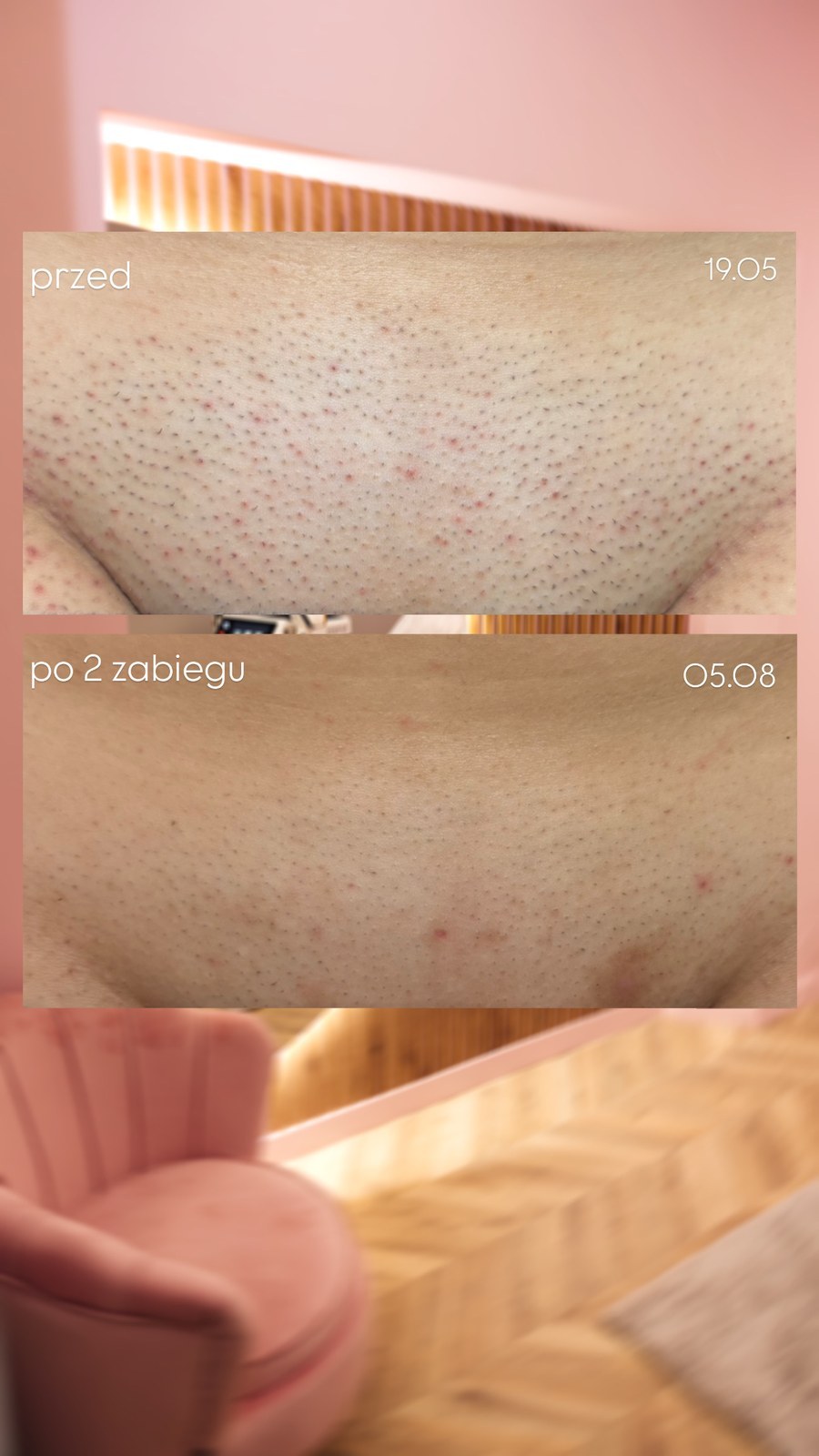 Efekt depilacji laserowej bikini — realny przypadek klientki LASERRIX Wrocław, po 2 zabiegach
