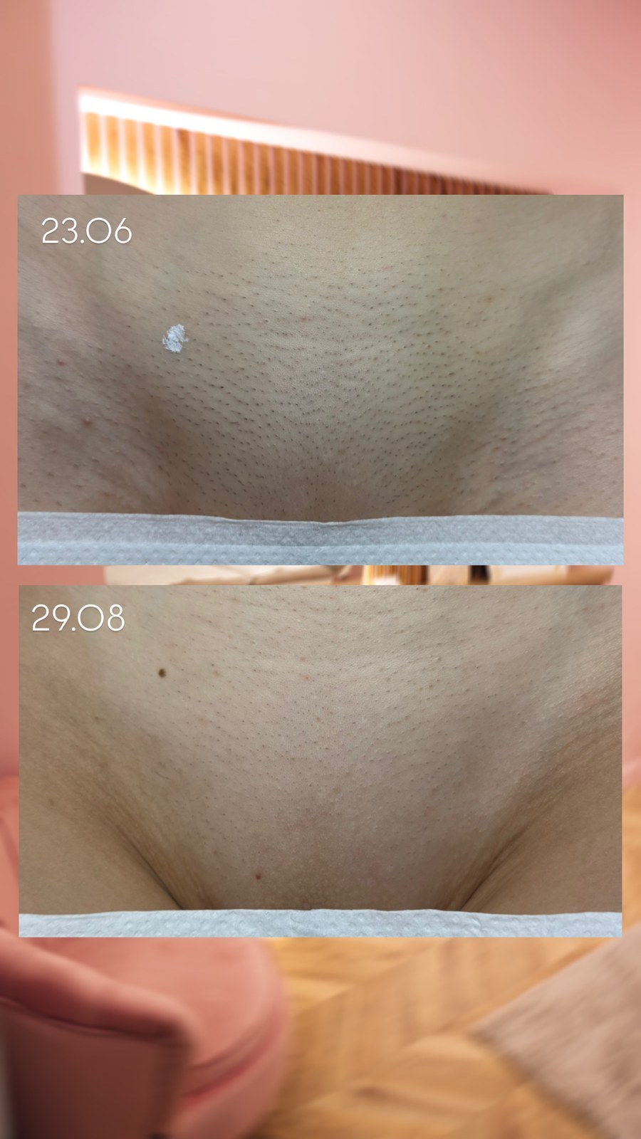Efekt depilacji laserowej bikini — realny przypadek klientki LASERRIX Wrocław