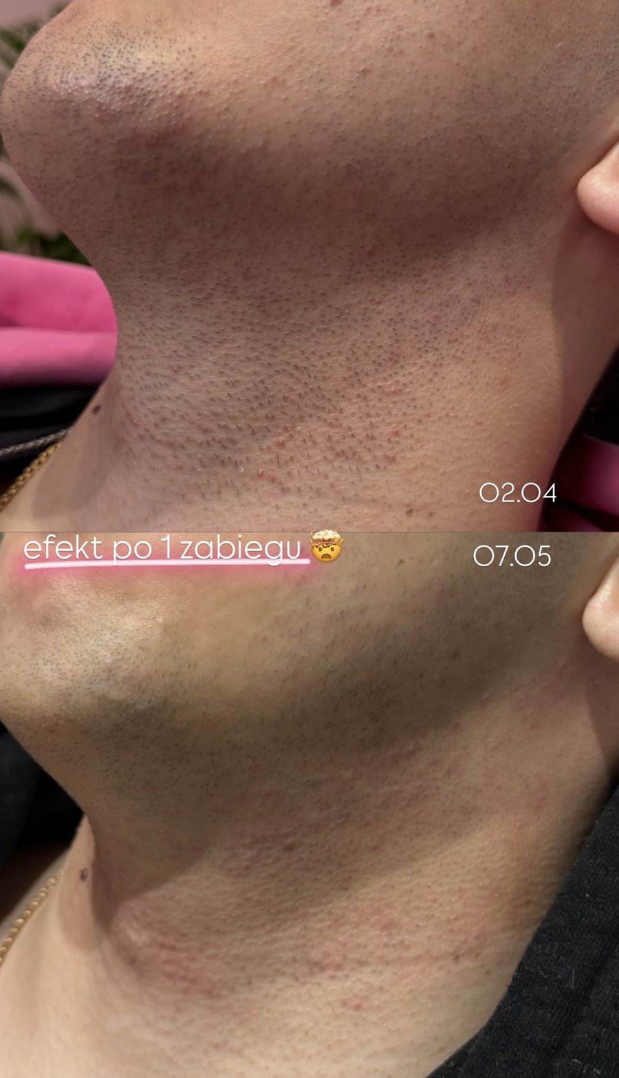 Broda i szyja — efekt po 1 zabiegu depilacji laserowej