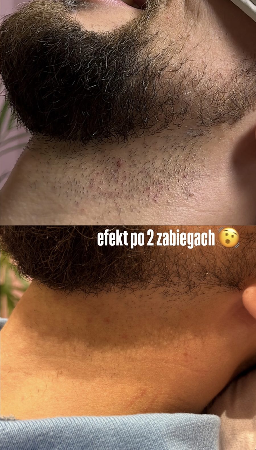 Broda i szyja — efekt po 2 zabiegach depilacji laserowej