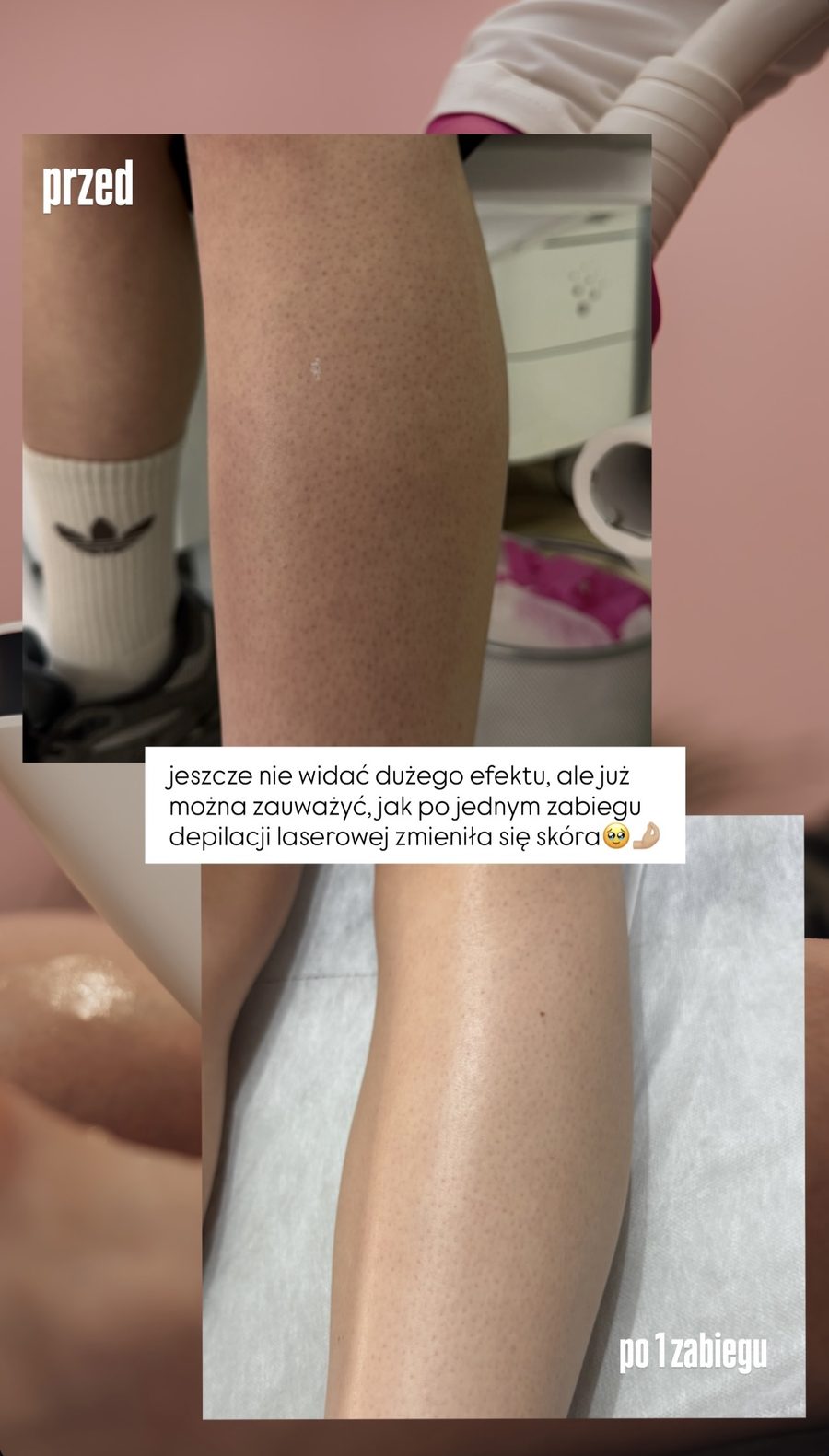 Nogi — efekt po 1 zabiegu depilacji laserowej
