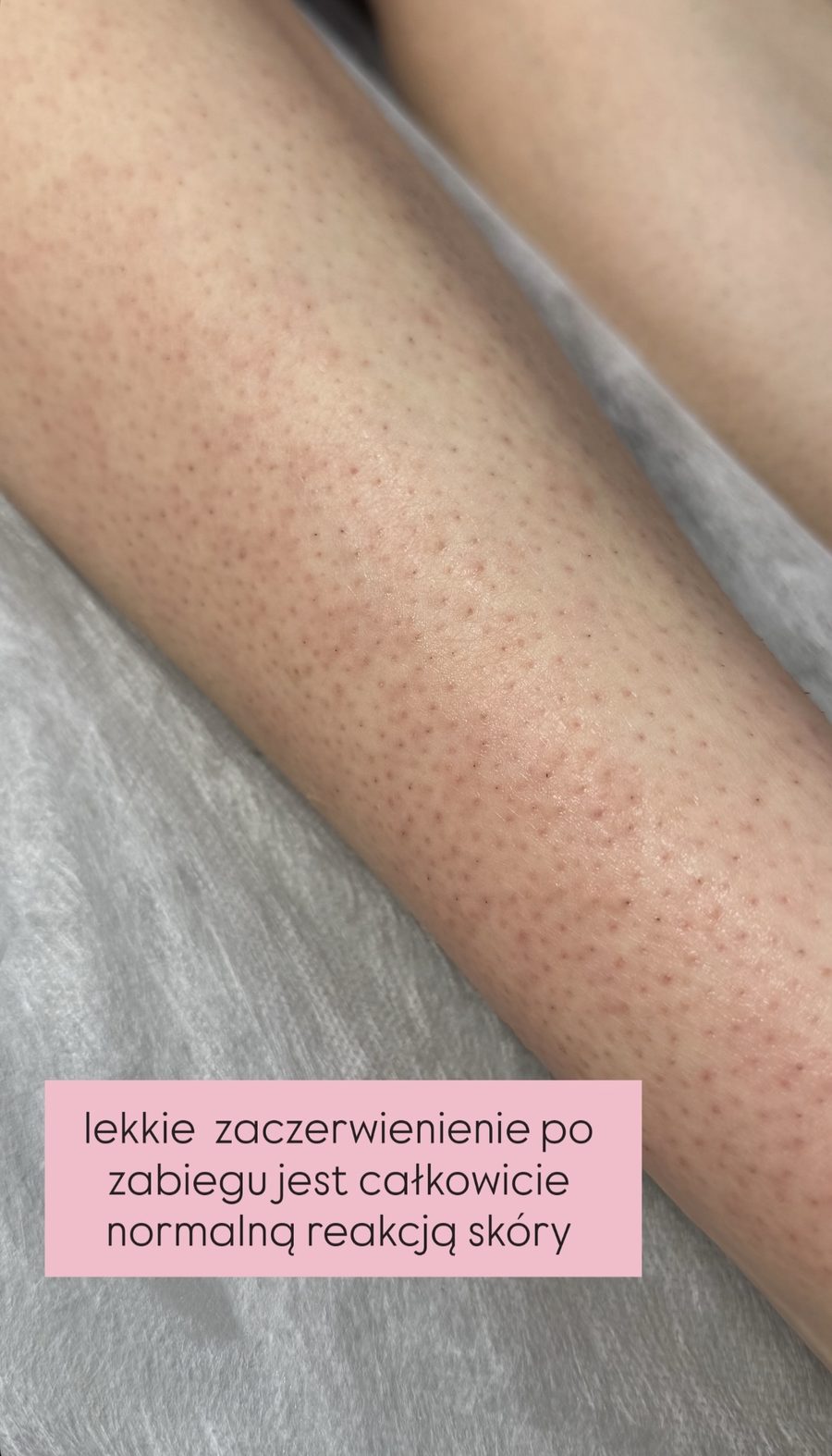 Nogi — normalna reakcja skóry po zabiegu depilacji laserowej