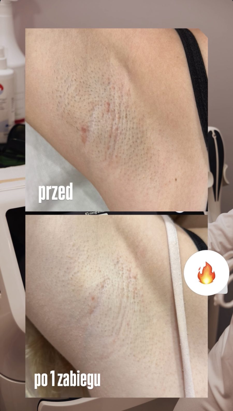 Pachy — efekt po 1 zabiegu depilacji laserowej