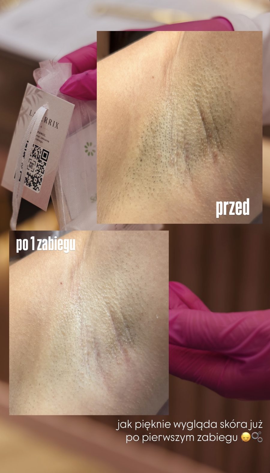 Pachy — efekt po 1 zabiegu depilacji laserowej