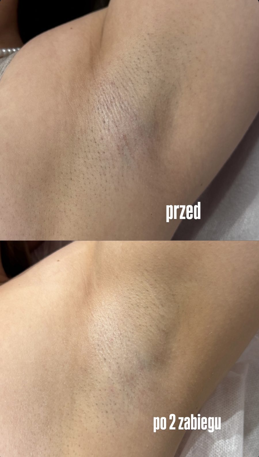 Pachy — efekt po 2 zabiegach depilacji laserowej