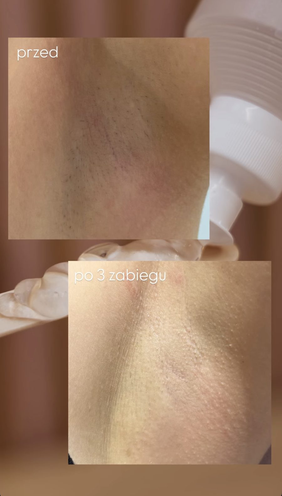 Pachy — efekt po 3 zabiegach depilacji laserowej