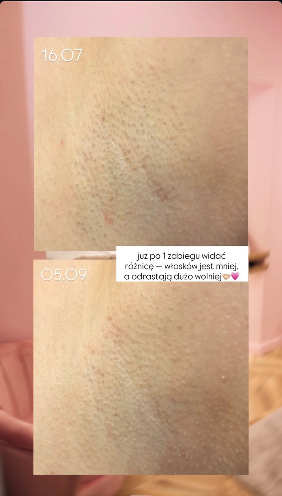 Efekt depilacji laserowej pach — realny przypadek klientki LASERRIX Wrocław, po 1 zabiegu