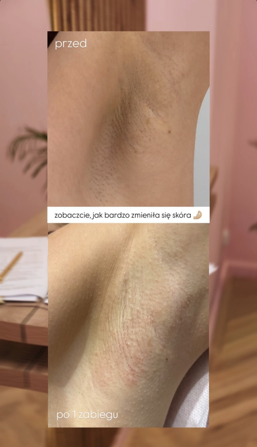 Efekt depilacji laserowej pach — realny przypadek klientki LASERRIX Wrocław, po 1 zabiegu